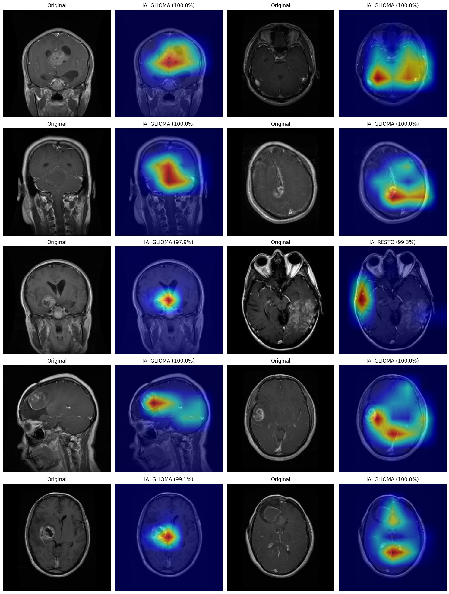 mri-glioma-yolo 1